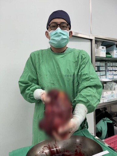 老婦腹痛就醫發現罕見巨大胃部基質腫瘤 手術成功
