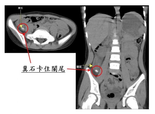 4歲幼童嘔吐腹痛誤為腸胃炎 檢查竟是急性闌尾炎破裂引發腹膜炎