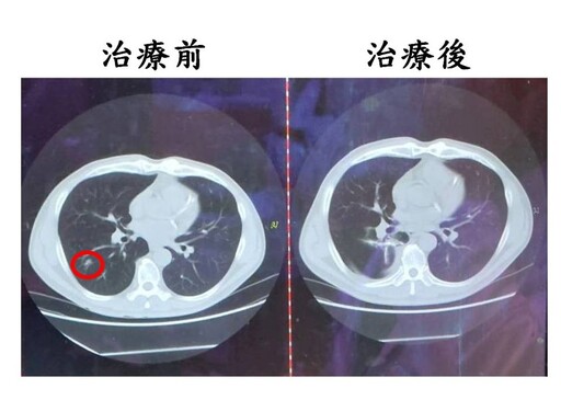 LDCT揪早期肺癌 搭配微創胸腔鏡手術 助扭轉病情