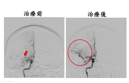 血栓溶解搭配動脈取栓術 黃金時間救治缺血型腦中風