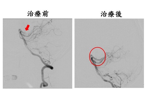血栓溶解搭配動脈取栓術 黃金時間救治缺血型腦中風