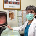婦健檢意外發現大腸癌前病變 內視鏡黏膜下剝離術免切腸