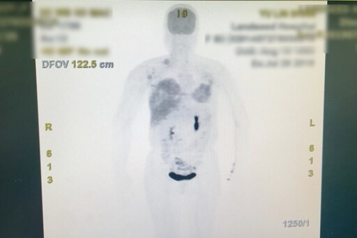 別因「腫瘤小」輕忽！聯新國際醫籲接受全面治療 降低乳癌復發率