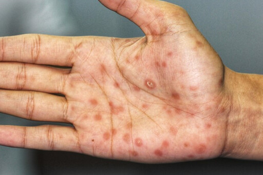 國中生全面免費接種HPV疫苗 聯新國際醫提醒這件事