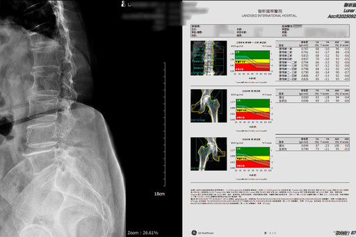 骨質疏鬆無聲無息恐致命 聯新國際醫教你3招守住「骨本」