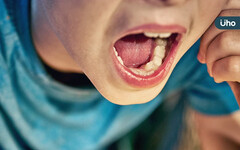 戽斗竟是牙齒「錯咬」造成！醫揭1時機快把握：錯過恐影響顎骨發育