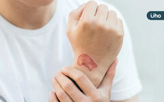傷口疤痕增生如何預防？已經留疤怎麼辦？除疤最好「●●天後」就開始
