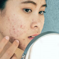 長痘痘是臉不乾淨，平常要多洗臉？中醫揭「1關鍵」千萬別過度清潔