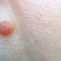 腹股溝冒小腫塊⋯「贅生皮」是什麼？醫警告：嚴重恐造成「皮膚壞死」