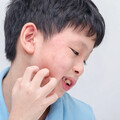 健保放寬口服小分子標靶藥給付至兩年 異位性皮膚炎迎來治療新曙光