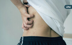 冬季癢靠清潔能改善？醫揭「3大壞習慣」越洗越乾：洗澡洗太久也算