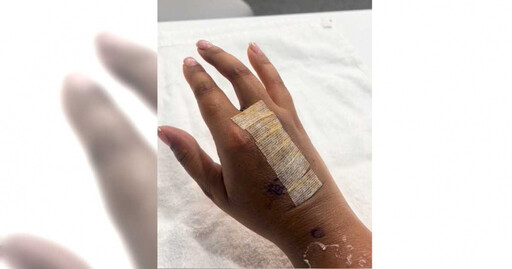 手指腫脹被誤診骨折 她2個月後被告知「是腫瘤」慘截肢