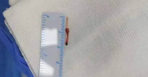 1.5cm針頭導管斷在嬰兒血管 「漂移5年」卡左臉腮腺留10公分疤痕