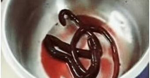 超噁!男子常吃生魚感染「世界最大人體寄生蟲」取出還在蠕動