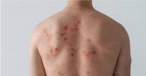 美國麻疹疫情肆虐11州 患者人數突破1千例「7成在德州」