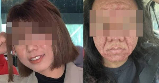 28歲女懷孕後「臉上長滿痘+皮膚下垂」 照鏡崩潰:像變成另一個人