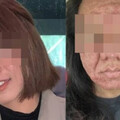 28歲女懷孕後「臉上長滿痘＋皮膚下垂」 照鏡崩潰：像變成另一個人