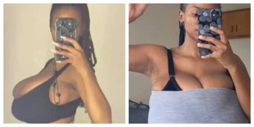 短短數月暴增至34G!25歲女確診「巨乳症」 痛到走不動靠募款動刀
