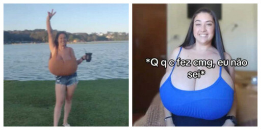 短短數月暴增至34G!25歲女確診「巨乳症」 痛到走不動靠募款動刀