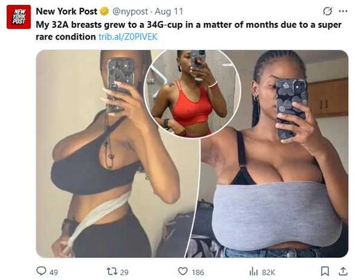 短短數月暴增至34G!25歲女確診「巨乳症」 痛到走不動靠募款動刀
