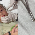 墨西哥男童海邊玩水耳朵突發癢 就醫竟夾出「活跳跳小螃蟹」