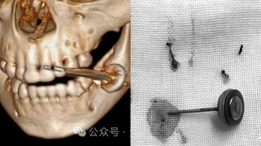 中國2歲童「好奇咬電池」釀爆炸！整張臉血肉模糊 送醫搶救撿回一命