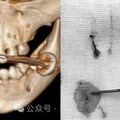 中國2歲童「好奇咬電池」釀爆炸！整張臉血肉模糊 送醫搶救撿回一命