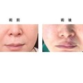 曹賜斌醫師《白疤顏色再生術》助患者揮別童年「偽」唇裂疤痕