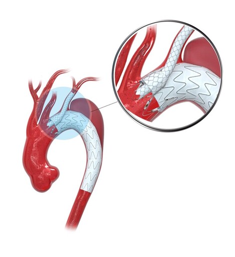 全球首創！先健主動脈分支重建系統(煙囪型)上市！定義煙囪技術新標準