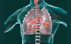 克服標靶藥副作用挑戰，平衡肺癌治療與生活品質