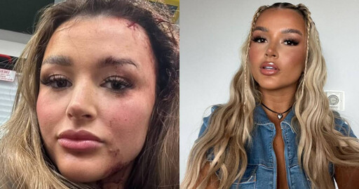24歲女網紅被認出…遭男粉絲重擊！ 前額慘留5公分縫疤