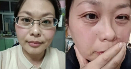 42歲女罹「斷崖式衰老」！20天臉上佈滿皺紋 「8生活習慣」加速老化
