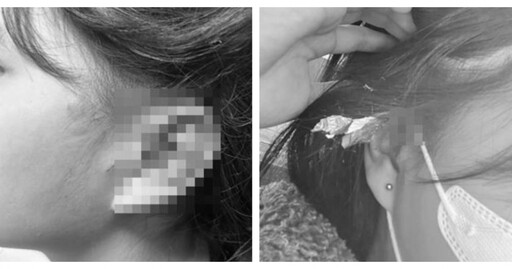 16歲少女逛三峽長福橋被炸耳 天外飛來沖天炮她「耳膜破裂」滲血照曝