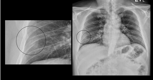 40歲男「咳嗽2個月」胸痛就醫 蘇一峰見X光片秒懂：肋骨斷了