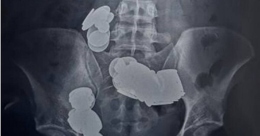 萬磁王？印度男為健身猛吞近80枚硬幣磁鐵 肚痛20天小腸竟「吸在一起」