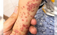 「同學染腸病毒」女兒被停課…家長怨「長一點點疹子」：有那麼嚴重嗎？ 醫曬一照全網炸鍋