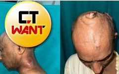 真硬頸！印度男頭頂「7公斤巨瘤」30年 手術移除變「光頭永澤」