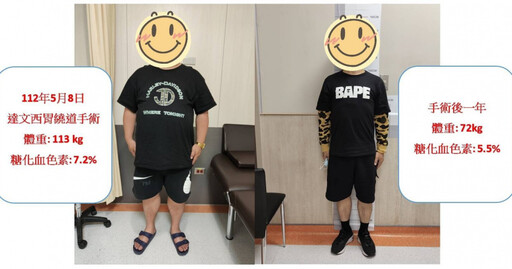 41歲男「月減40公斤」甩掉糖尿病 達文西手術