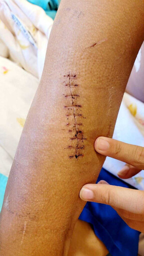 中捷受傷高中生住院11天順利康復 出示傷疤「宛如12公分蜈蚣」報平安