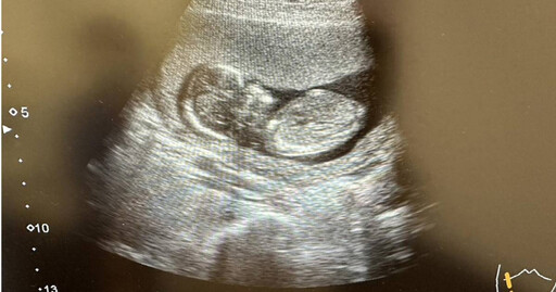 「小姐姐」腹脹2周急求助 照超音波竟有「寶寶」才知懷孕