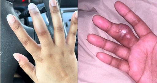 手指腫脹被誤診骨折 她2個月後被告知「是腫瘤」慘截肢
