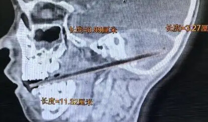 驚悚！6歲童吃麥芽糖不慎摔倒「12cm竹籤」貫穿頭顱險丟命