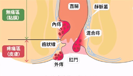 痔瘡雷射消融術 創傷更小術後恢復快