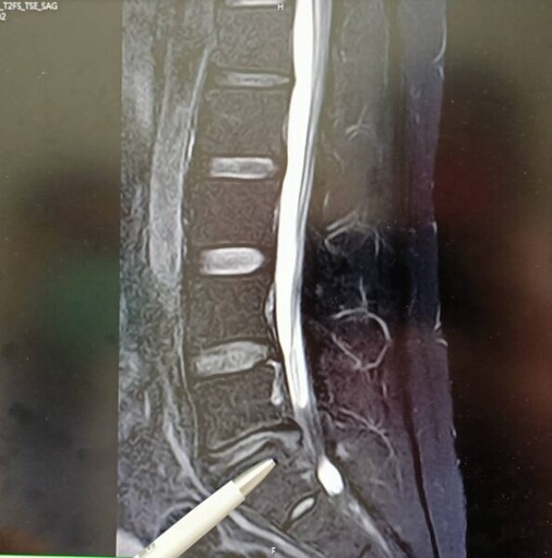 31歲男搬香蕉後左臀劇痛靠打針過活 七賢脊椎外科醫院微創術後一週行走輕鬆自如！