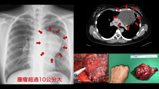 縱膈腔10公分巨形畸胎瘤 女子來台就醫 順利摘除巨型腫瘤