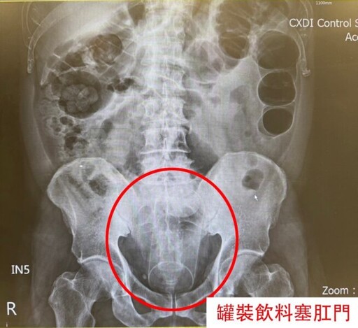 肛門塞罐裝飲料 醫微創手術取出