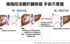 高雄長庚首創兩階段活體肝移植 幫助肝臟體積過小之捐贈者 捐肝救家人