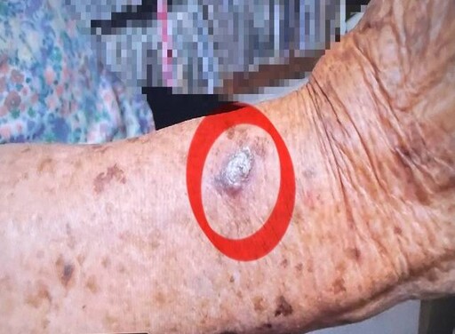 田寮區衛生所遠距醫療見成效 高雄榮總醫師隔空揪高齡長輩皮膚疾患 醫學中心等級駐診實現醫療平權