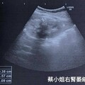 28歲輕熟女臉灰黑 水腫 啤酒尿 壓力、漏服藥致血糖失控，尿毒洗腎提早到來
