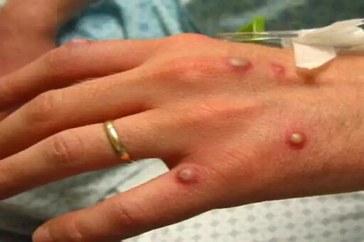猴痘已蔓延全球至少16國！猴痘是什麼？如何傳染？會有哪些症狀？打天花疫苗就能預防嗎？